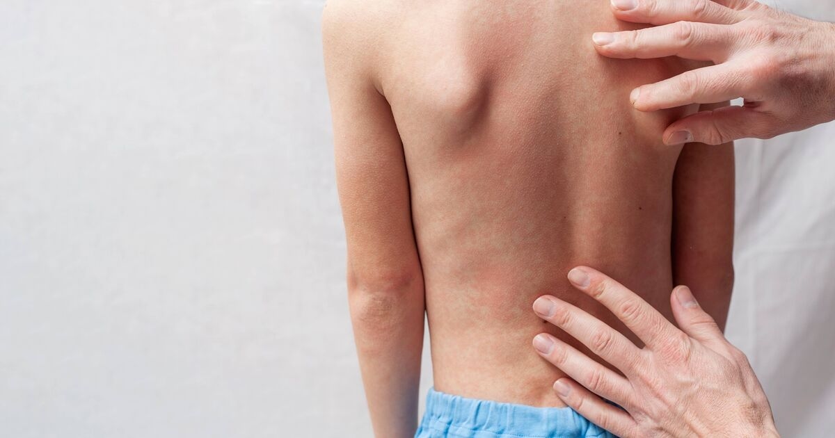 Warnung der UKHSA vor hoch ansteckender Krankheit