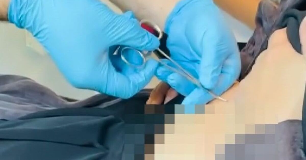 He went to the hospital complaining of weakness! A tick came out of his stomach