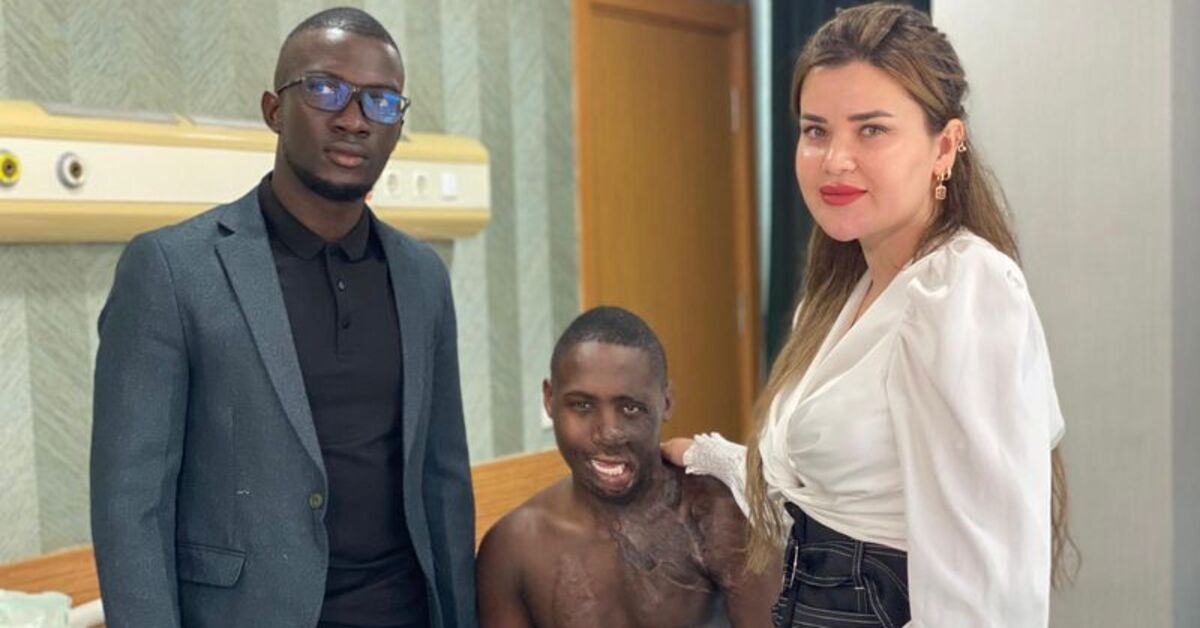 Yüzü yanan Ugandalı çobana Ankara'da tedavi