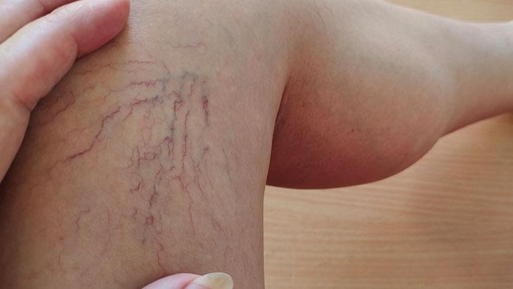 В последние годы это стало всё более распространённым! Эти ошибки приводят к варикозному расширению вен.