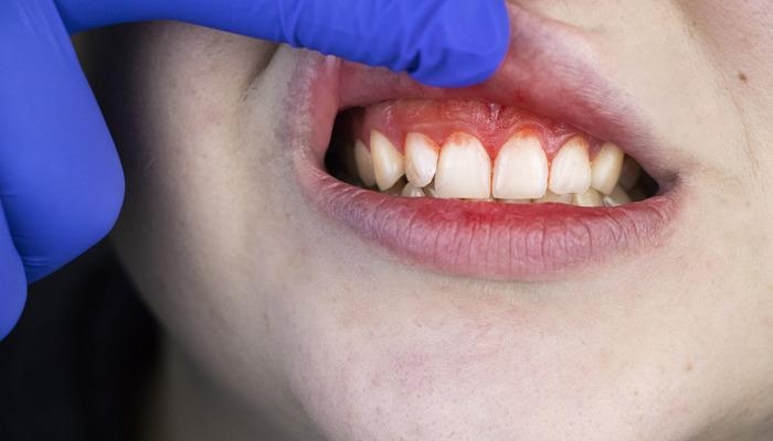 Don't just say it's simple and dismiss it: This symptom in the mouth may be the first sign of leukemia! It starts suddenly