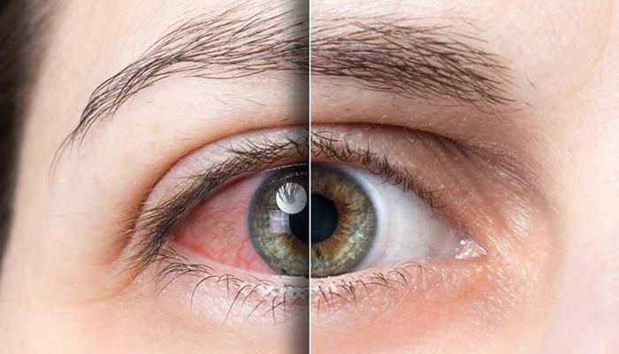Don't underestimate your eye health! No more burning and stinging complaints: "Dry eye disease reduces the quality of life"