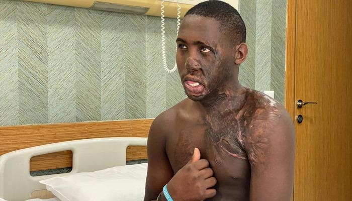 A painful wait: Ugandan shepherd with severe burns on his face and neck received treatment in Türkiye after 10 years...
