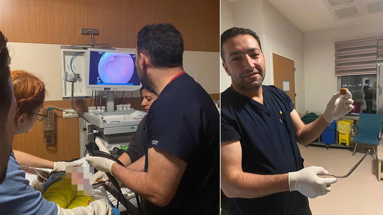 Zihinsel engelli kadının yemek borusuna kaçan ceviz, operasyonla çıkarıldı