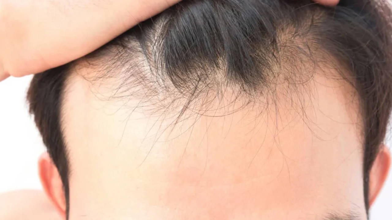 The hidden reason for hair loss: How effective is vitamin and mineral deficiency?