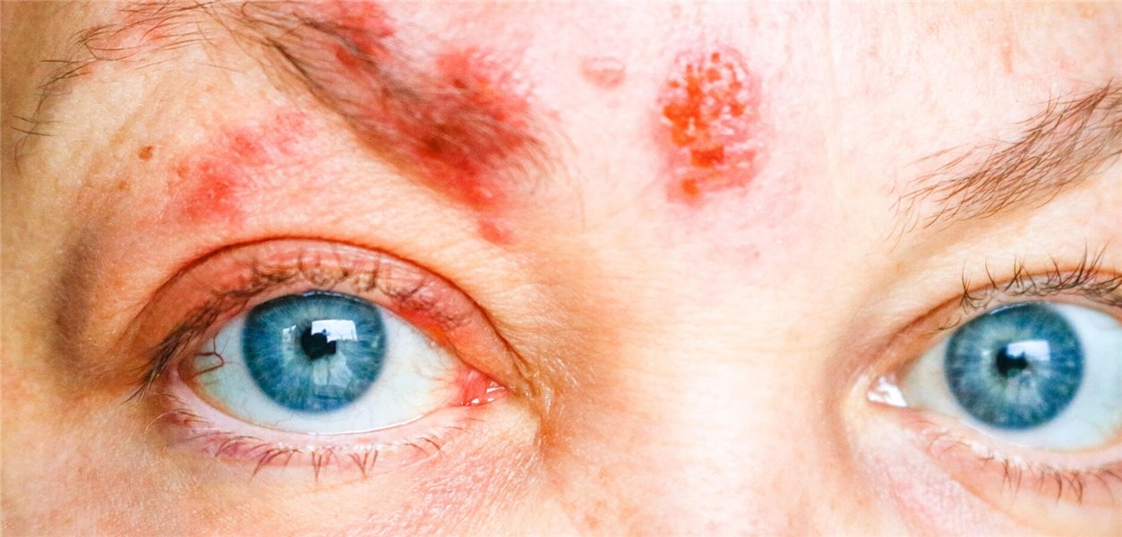 Long-term antiviral therapy appears to benefit only subgroups with zoster ophthalmicus