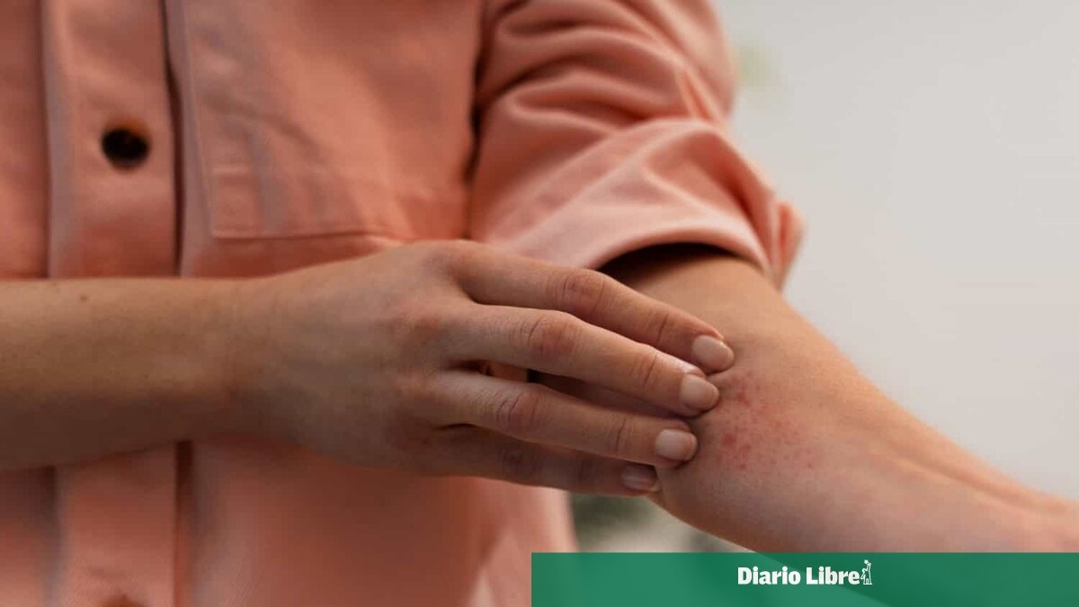 Dermatitis por calor: claves para reconocerla y prevenirla